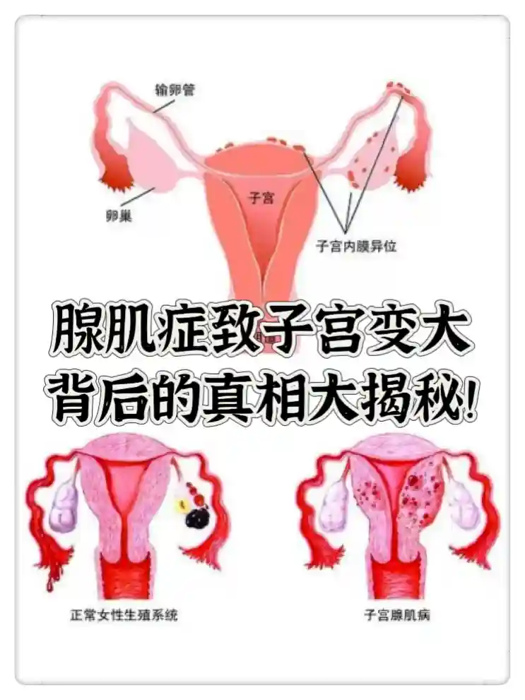 腺肌症导致子宫变大：病因与影响深度解析